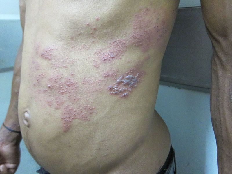 Shingles Recovery